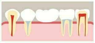 Le remplacement des dents absentes