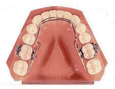 LES APPAREILS ORTHODONTIQUES - DESCRIPTION