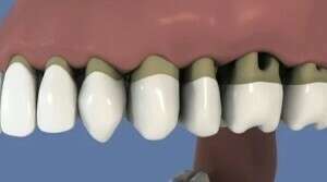 Brossette intedentaire et parodontite