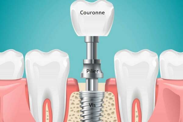 Les différentes pièces d’un implant