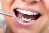 Appareil orthodontique lingual visible dans un miroir dentaire
