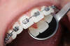 bouche avec bagues métalliques pour traitement orthodontique