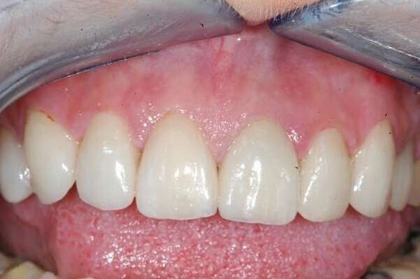 1.FACETTES - DR OHANA - DENTISTE À COURBEVOIE 92400