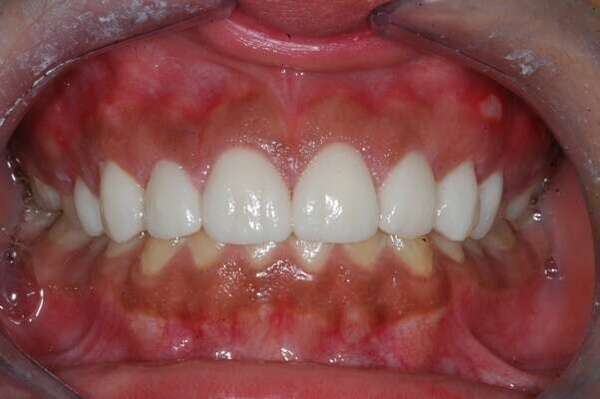 2. FACETTES AVEC AMÉNAGEMENT DES GENCIVES - DR OHANA - DENTISTE À COURBEVOIE 92400