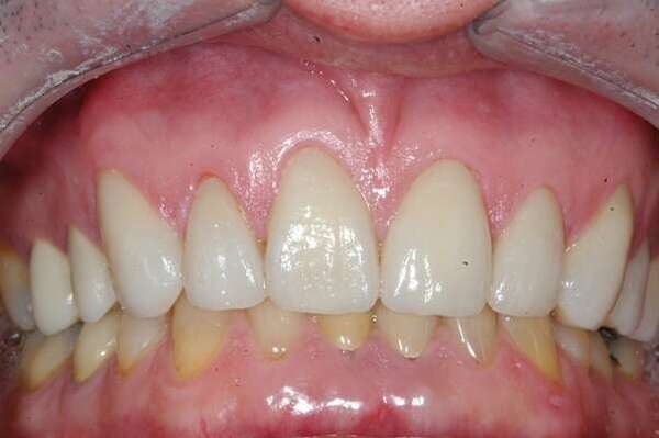 3. FACETTES - DR OHANA - DENTISTE À COURBEVOIE 92400