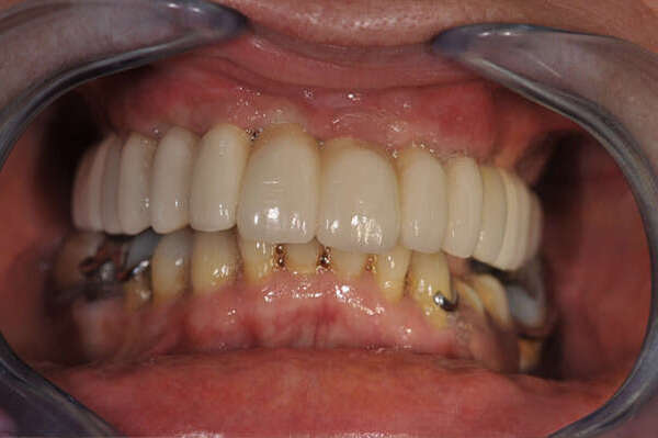 4. IMPLANT : POSE D'UN BRIDGE - DR OHANA - DENTISTE À COURBEVOIE 92400