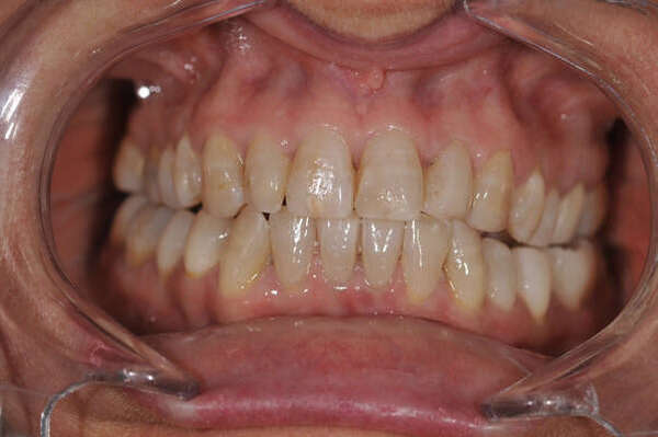 5. ORTHODONTIE : ALIGNEURS INVISIBLES - DR OHANA - DENTISTE À COURBEVOIE 92400