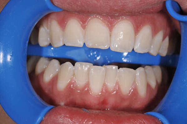 6. BLANCHIMENT DENTAIRE - DR OHANA - DENTISTE À COURBEVOIE 92400