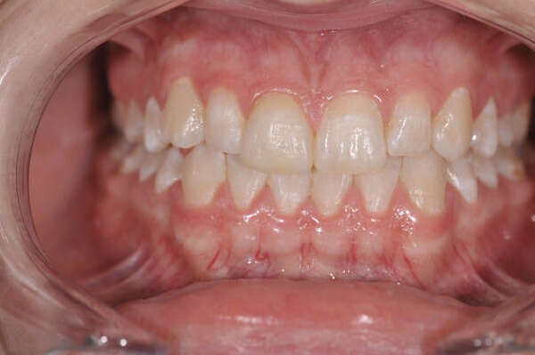 7. FACETTES CÉRAMIQUES - DR OHANA - DENTISTE À COURBEVOIE 92400