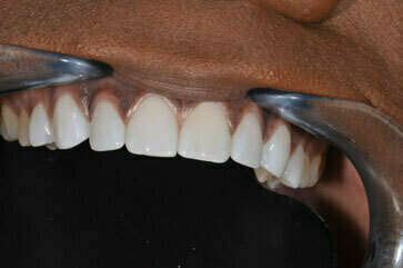 8. RÉALISATION DE FACETTES EN CÉRAMIQUE SANS PRÉPARATION DES DENTS - DENTISTE À COURBEVOIE 92400