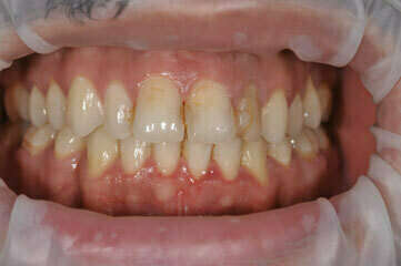 9. RÉALISATION DE 8 FACETTES CÉRAMIQUE SANS PRÉPARATION SUR LES DENTS DU HAUT - DENTISTE À COURBEVOIE 92400