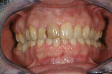 11. RÉALISATION DE 8 FACETTES CÉRAMIQUES SUR LES DENTS DU HAUT - DENTISTE 92400
