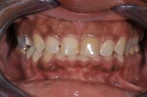 13. 8 FACETTES CÉRAMIQUES - DR OHANA - DENTISTE À COURBEVOIE 92400