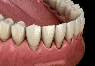 LES PARODONTITES (DÉCHAUSSEMENT DES DENTS) - DR OHANA - DENTISTE À COURBEVOIE 92400