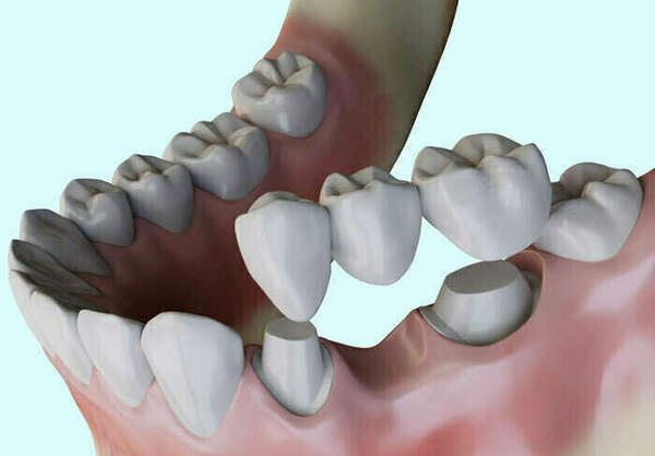 LES BRIDGES ET PONTS DENTAIRES - DR OHANA - DENTISTE À COURBEVOIE 92400
