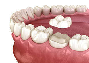 LES DIFFÉRENTS TYPES DE PROTHÈSES DENTAIRES - DR OHANA - DENTISTE À COURBEVOIE 92400