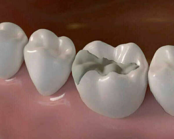 INLAY ET ONLAY, UNE TECHNIQUE CONSERVATRICE