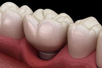 LA PÉRI-IMPLANTITE - DR OHANA - DENTISTE À COURBEVOIE 92400