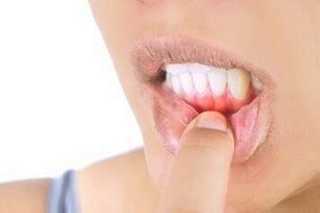 LA MISE EN CHARGE IMMÉDIATE D’UNE PROTHÈSE SUR UN IMPLANT - DR OHANA - DENTISTE À COURBEVOIE 92400