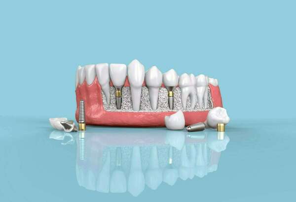 L'IMPLANTOLOGIE DENTAIRE