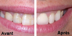 Cas pratiques réalisés au cabinet dentaire du docteur Assoun - St Jory - près de Toulouse