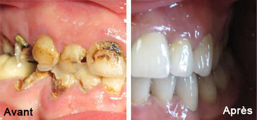 Cas de réhabilitation réalisé au cabinet dentaire du docteur Assoun - St Jory - près de Toulouse