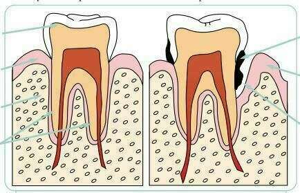 Les maladies parodontales