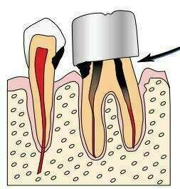 Les couronnes “bagues”