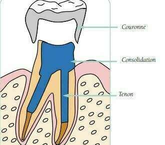 Les dents dévitalisées