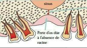 Les Implants