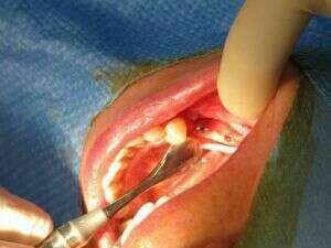 Cas d'implant réalisé au cabinet dentaire du docteur Assoun - St Jory - près de Toulouse