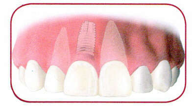 Les implants dentaires : près de Toulouse - Saint jory