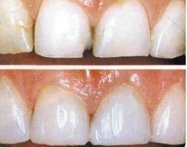 Les Facettes Céramique