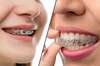 braces-vs-invisalign-hero___Source
