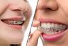 braces-vs-invisalign-hero___Source