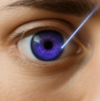 chirurgie des yeux au laser