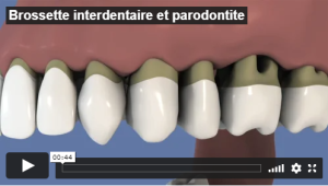 Brossette interdentaire et parodontite