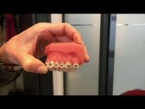 QUE FAIRE EN CAS DE BAGUE DÉCOLLÉE