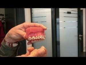 DERNIÈRE BAGUE DÉCOLLÉE