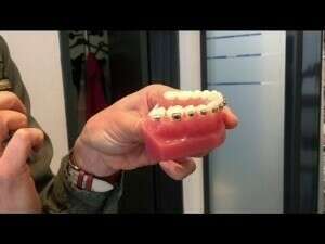 ARC QUI DÉPASSE ET/OU AYANT COULISSÉ