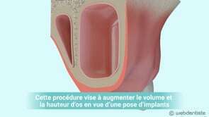 Comblement de sinus par voie latérale (sinus lift) avec implantation différée