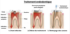 Schéma traitement endodontique étapes infection nettoyage canaux