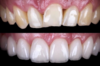 Comparaison dentition avant après facettes pelliculaires esthétiques