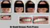 Comparaison dentition avant après facettes pelliculaires esthétiques