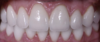 Facette dentaire en porcelaine pour sourire hollywoodien parfait