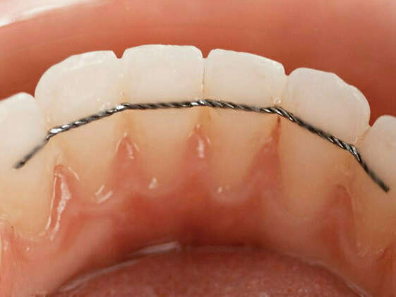 contention-orthodontie