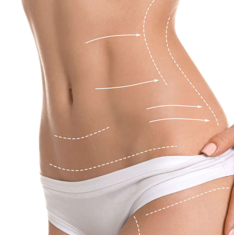 Lipocavitation