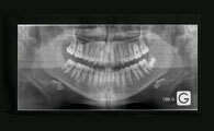 PREMIERE CONSULTATION ET BILAN ORTHODONTIQUE