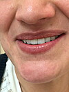 Réhabilitation esthétique maxillaire supérieur
