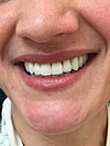 Réhabilitation esthétique maxillaire supérieur